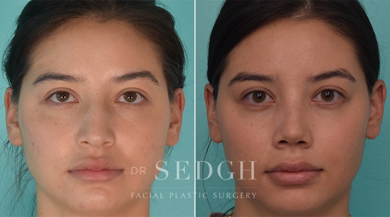 Rhinoplasty Before and After | Sedgh