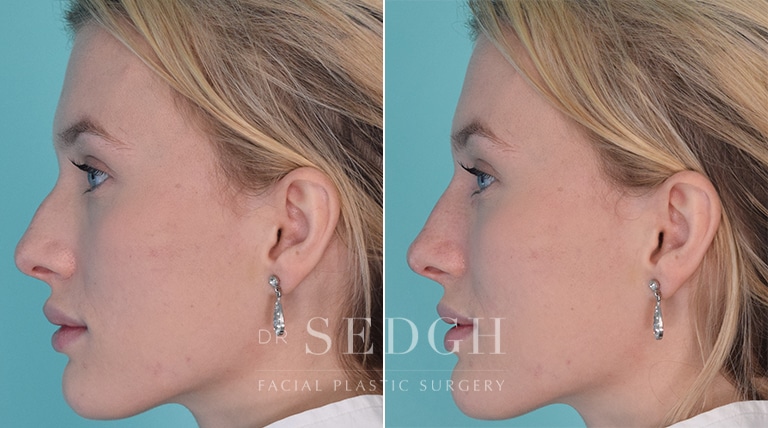 Non-Surgical Facelift