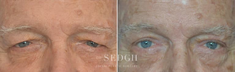 Eyelid Surgery