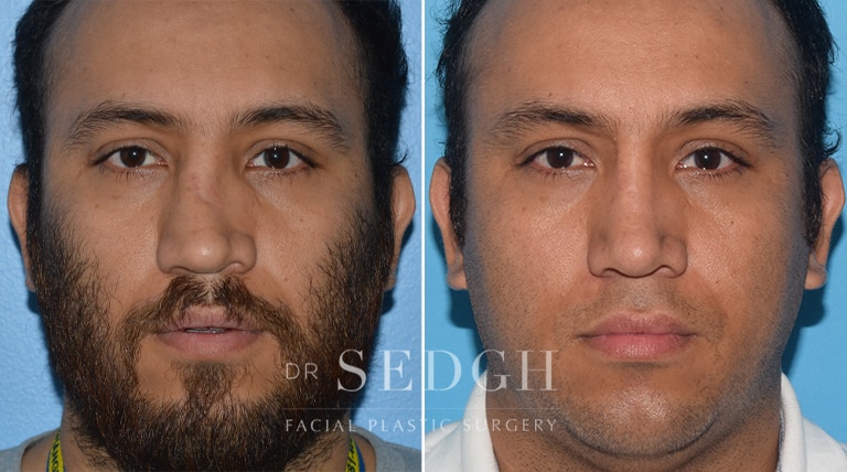 Rhinoplasty Before and After | Sedgh