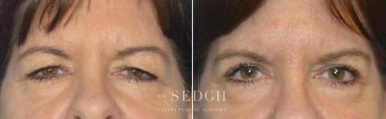 Eyelid Surgery