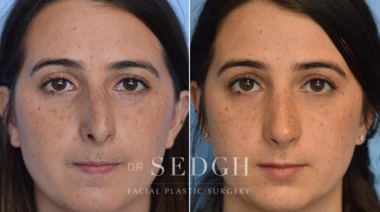 Rhinoplasty Before and After | Sedgh