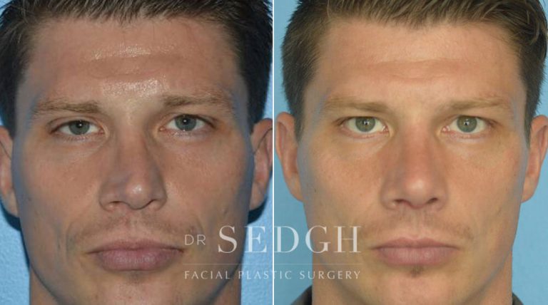 Rhinoplasty Before and After | Sedgh