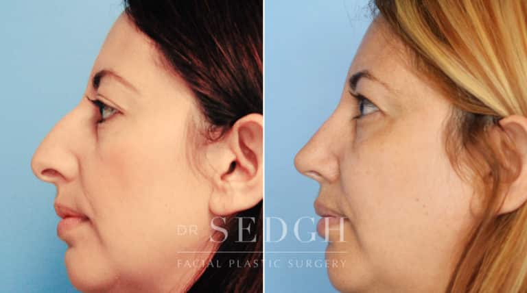 Rhinoplasty Before and After | Sedgh