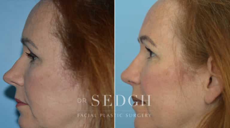 Rhinoplasty Before and After | Sedgh