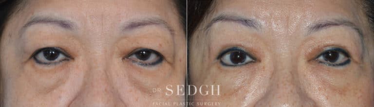 Asian Eyelid Surgery