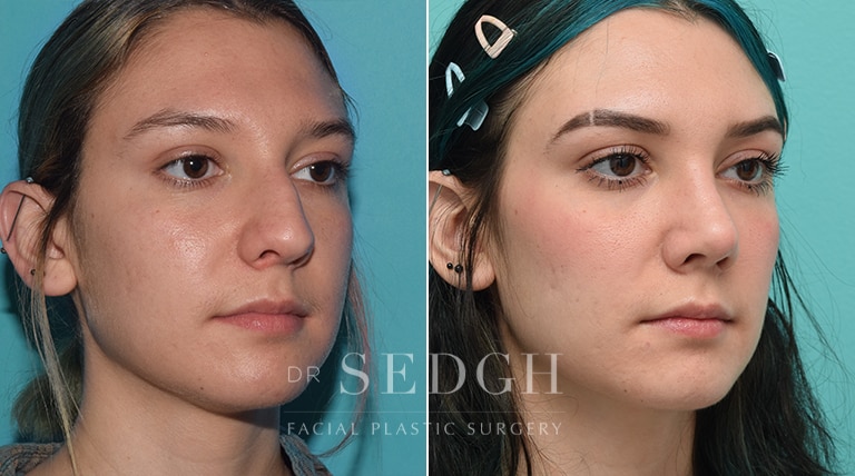 Rhinoplasty Before and After | Sedgh