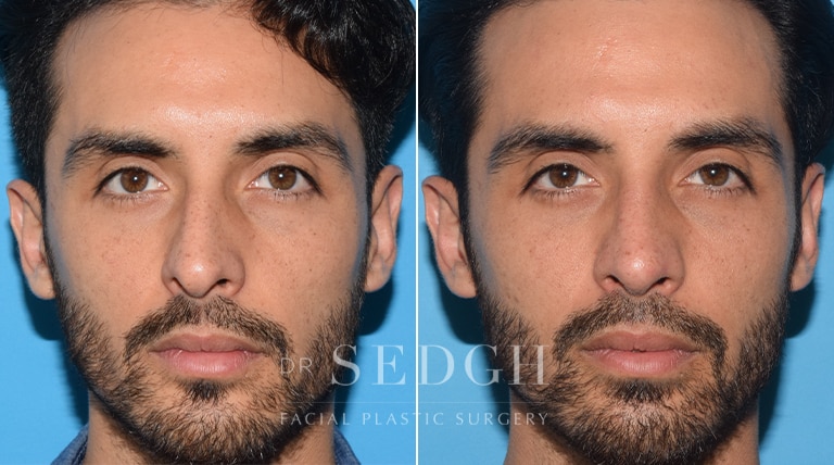 Rhinoplasty Before and After | Sedgh