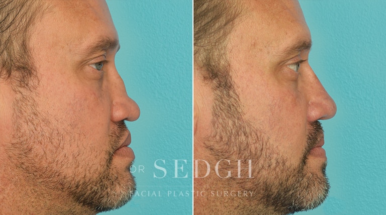 Rhinoplasty Before and After | Sedgh