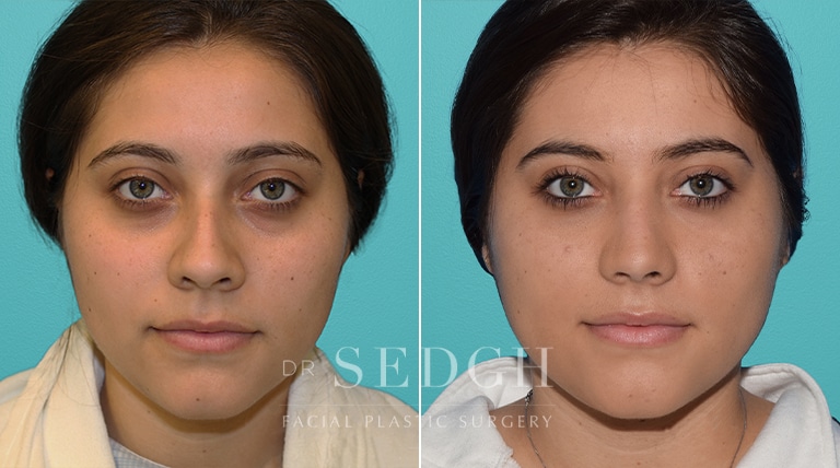 Rhinoplasty Before and After | Sedgh