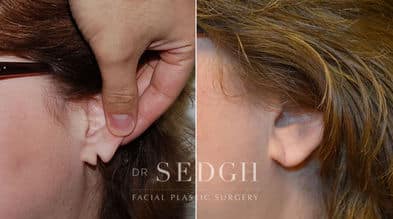 Ear Lobe Repair Before and After | Sedgh