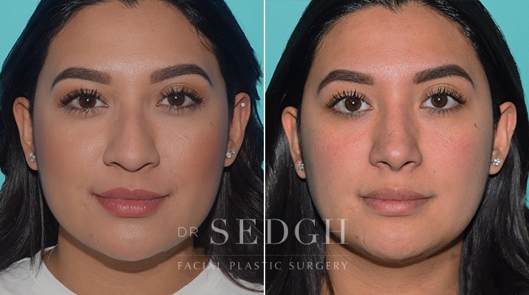 Rhinoplasty Before and After | Sedgh