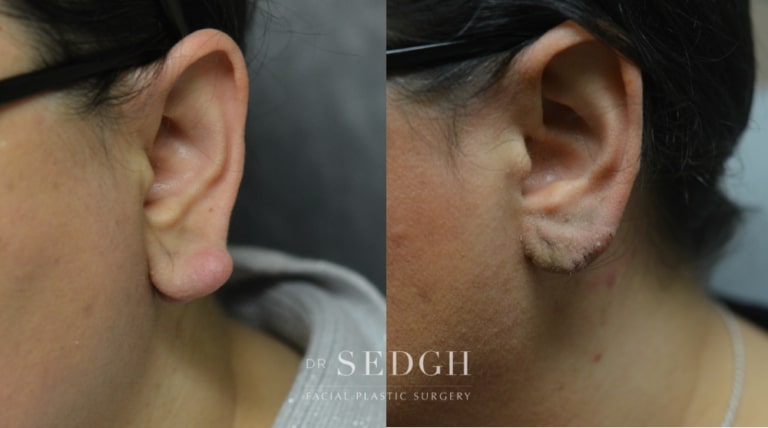 Ear Lobe Repair Before and After | Sedgh