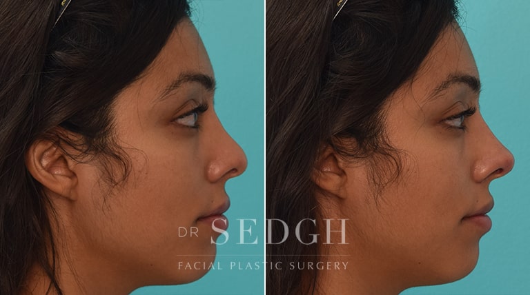 Facial Fillers Before and After | Sedgh