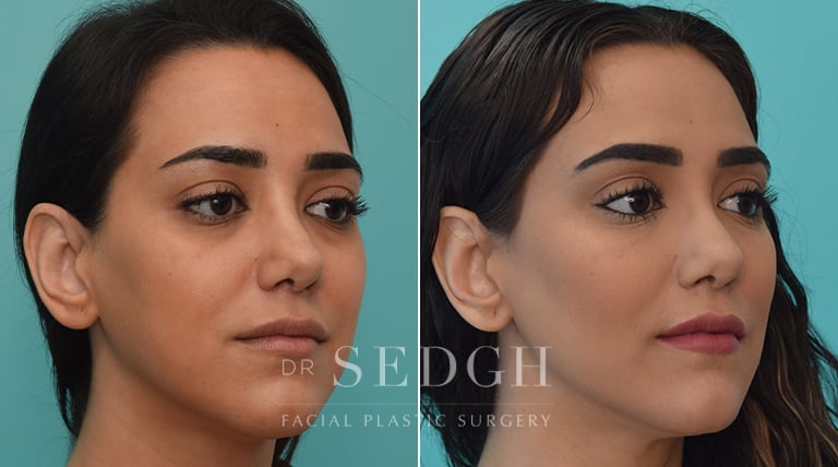 Facial Fillers Before and After | Sedgh