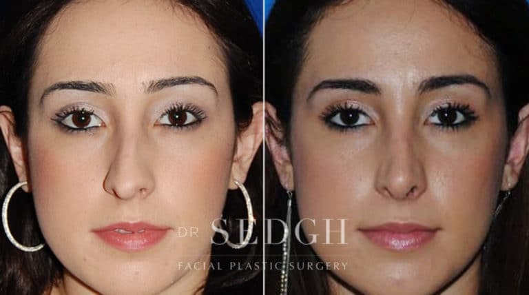 Rhinoplasty Before and After | Sedgh