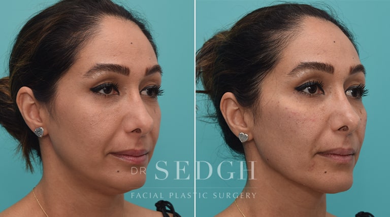 Facial Fillers Before and After | Sedgh