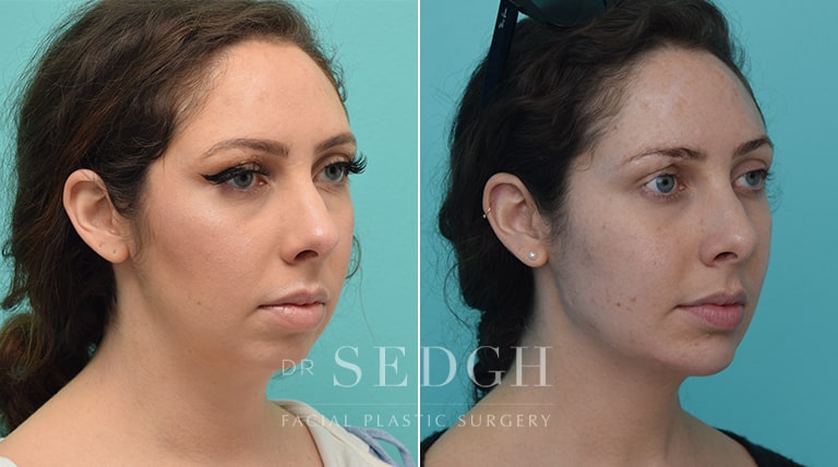 Facial Fillers Before and After | Sedgh