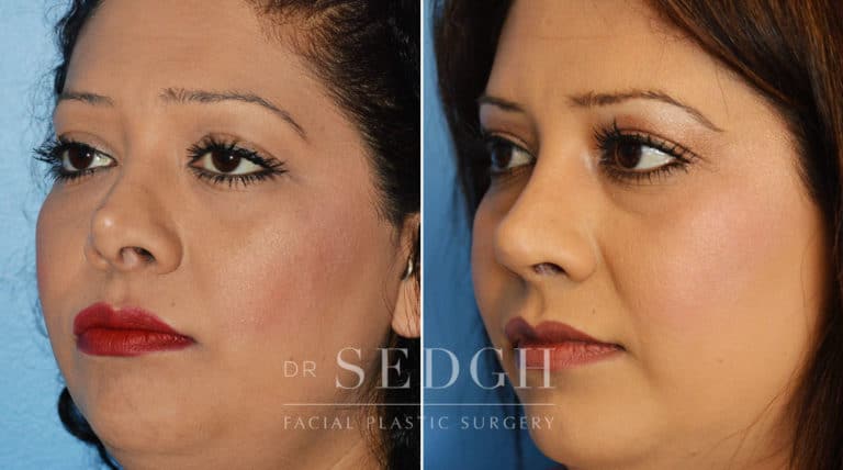 Nasal Fracture Before and After | Sedgh