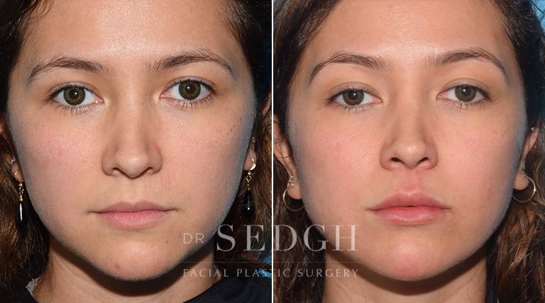 Facial Fillers Before and After | Sedgh