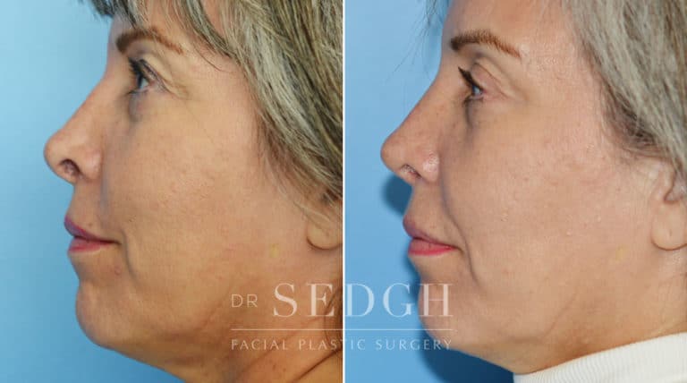 Revision Rhinoplasty Before and After | Sedgh