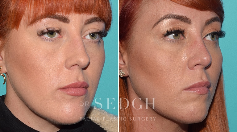 Facial Fillers Before and After | Sedgh