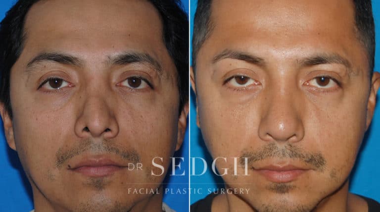 Revision Rhinoplasty Before and After | Sedgh