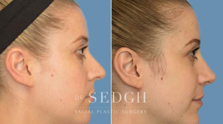 Rhinoplasty Before and After | Sedgh