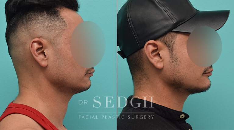 Facial Fillers Before and After | Sedgh