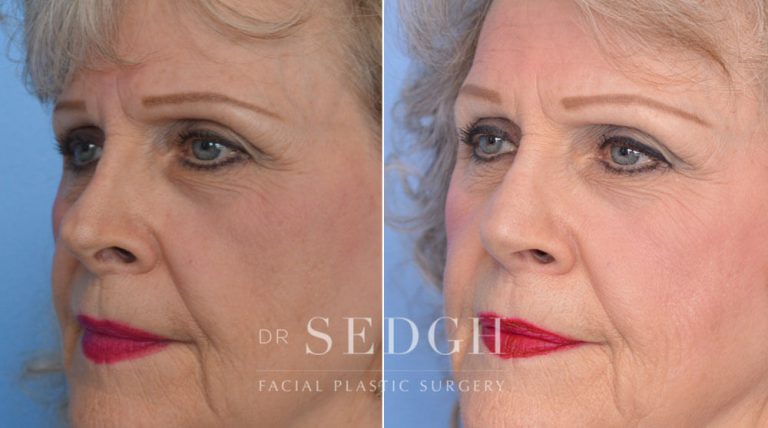 Revision Rhinoplasty Before and After | Sedgh