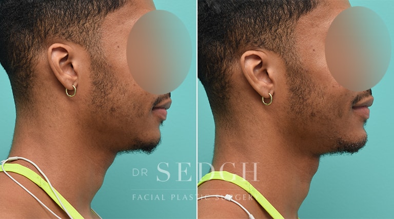 Facial Fillers Before and After | Sedgh