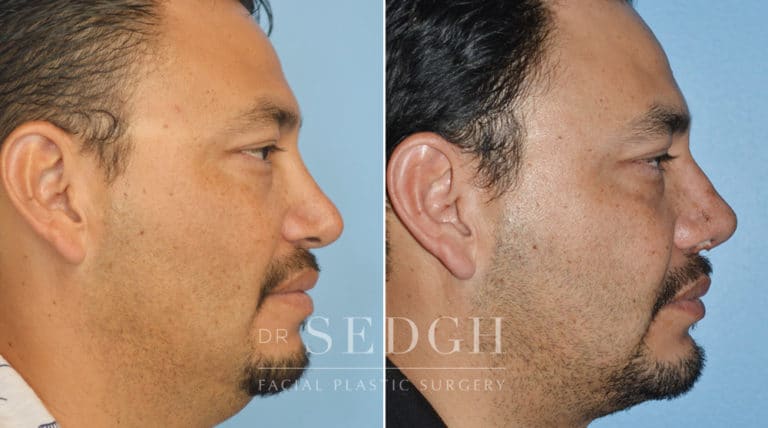 Revision Rhinoplasty Before and After | Sedgh