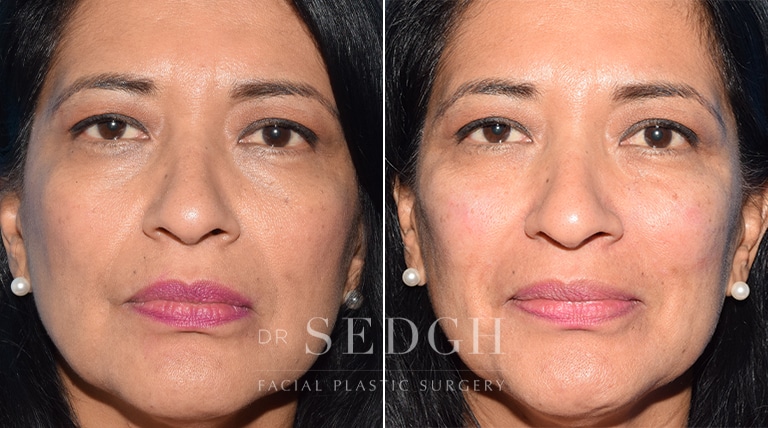 Facial Fillers Before and After | Sedgh