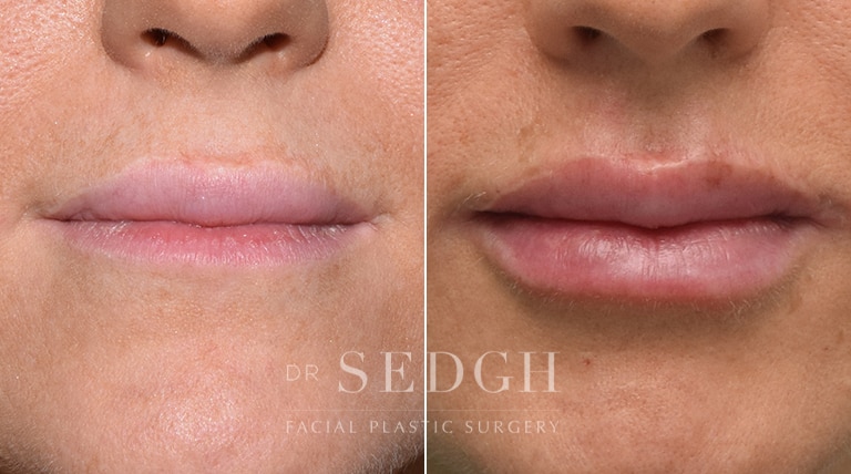 Lip Augmentation Before and After | Sedgh