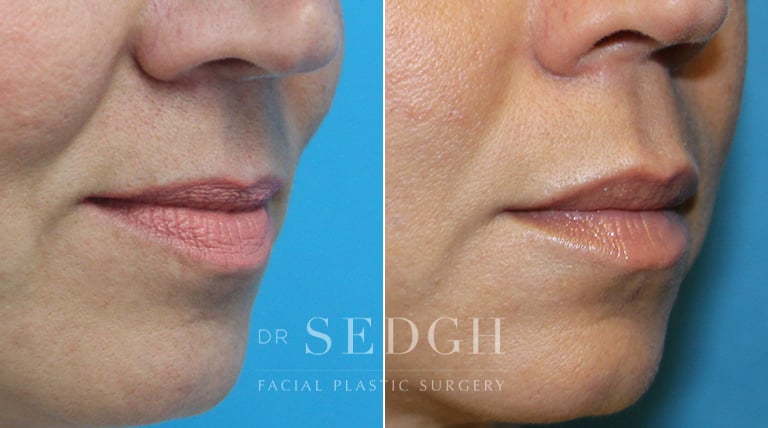 Lip Augmentation Before and After | Sedgh