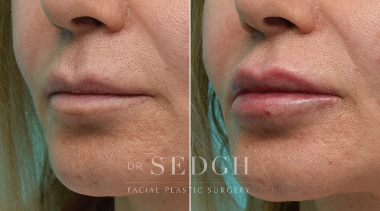 Lip Augmentation Before and After | Sedgh