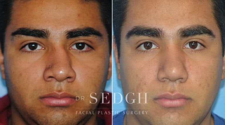 Crooked Nose Surgery Before and After | Sedgh