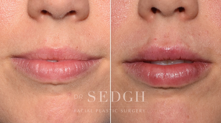 Lip Augmentation Before and After | Sedgh