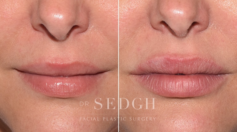 Lip Augmentation Before and After | Sedgh