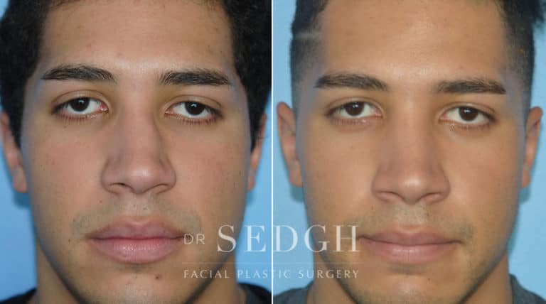 Crooked Nose Surgery Before and After | Sedgh