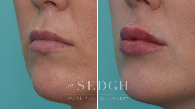 Lip Augmentation Before and After | Sedgh