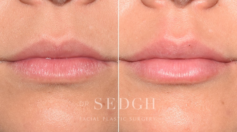 Lip Augmentation Before and After | Sedgh