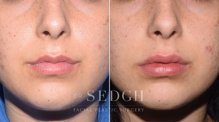 Lip Augmentation Before and After | Sedgh