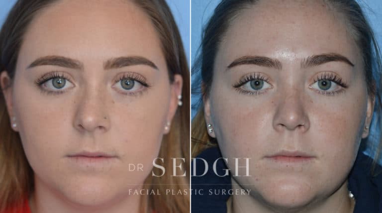 Crooked Nose Surgery Before and After | Sedgh
