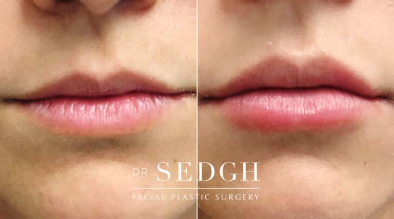 Lip Augmentation Before and After | Sedgh