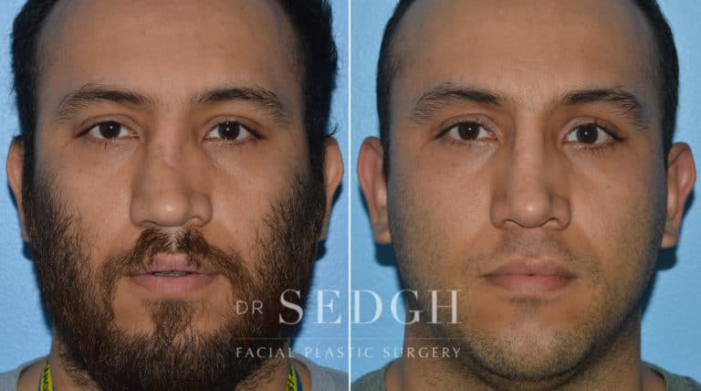 Crooked Nose Surgery Before and After | Sedgh