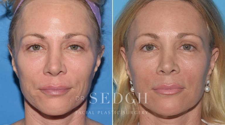 Laser Skin Treatments Before and After | Sedgh