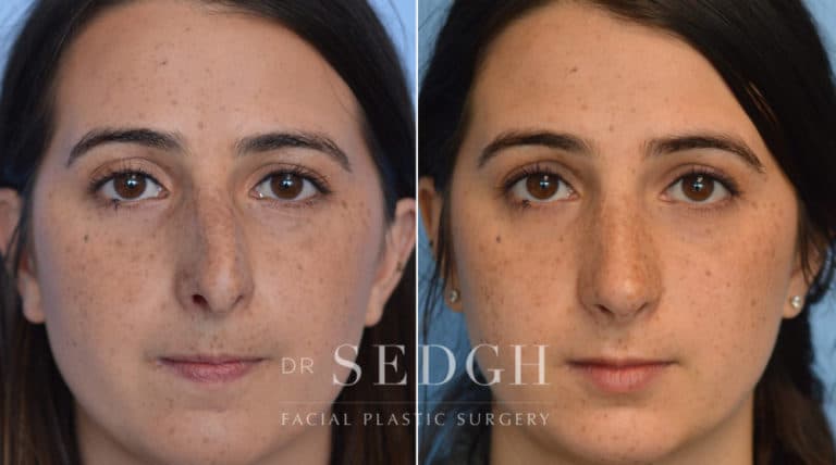 Crooked Nose Surgery Before and After | Sedgh