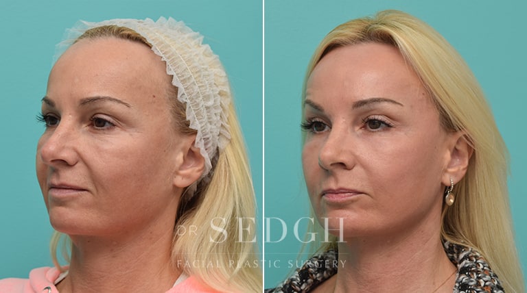 Laser Skin Treatments Before and After | Sedgh