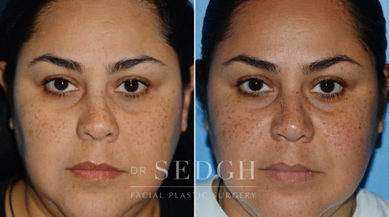 Crooked Nose Surgery Before and After | Sedgh